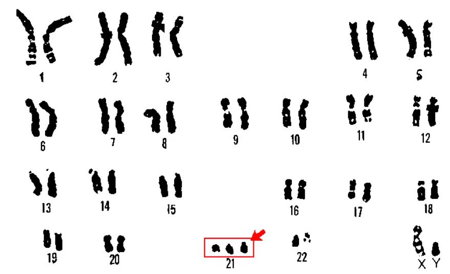 Caryotype (ensemble des chromosomes d'une cellule) d'un homme atteint de trisomie 21• Crédits : U.S. Department of Energy Human Genome Program